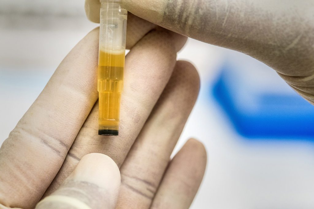 Common Reasons for Blood in Your Urine
