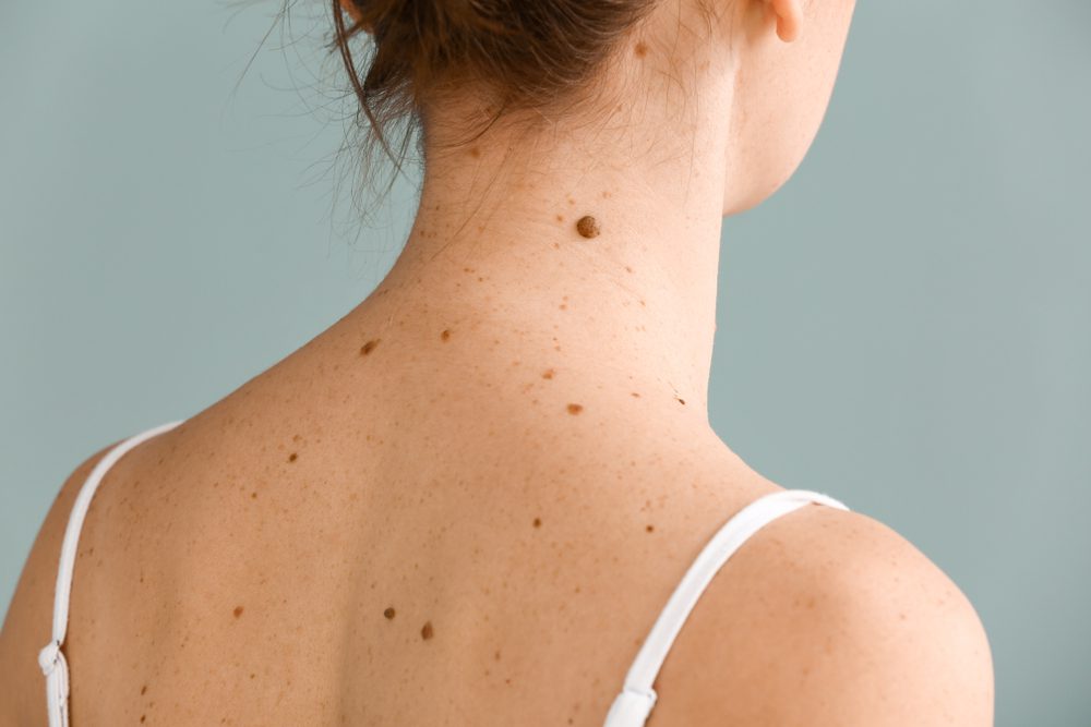 Is this mole normal?